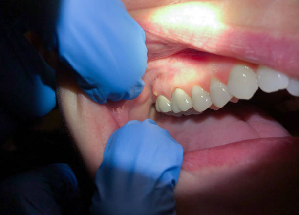 Best Emergency Wisdom Teeth Removal in Apalachicola, FL
